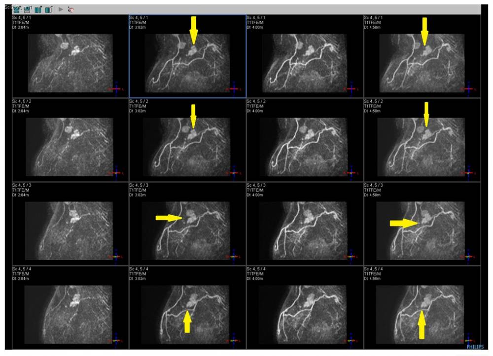 Risonanza magnetica della mammella - Clicca per ingrandire