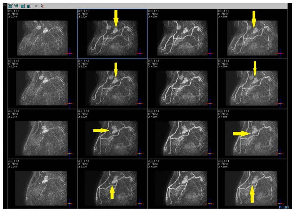 Risonanza magnetica della mammella - Clicca per ingrandire